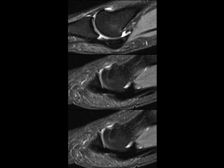 Figure 4 for case fibular sesamoid of metatarsal head ( RID2990 )